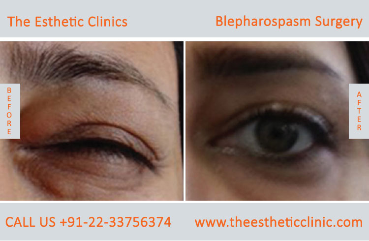Blepharospasm Treatment, Eyelid Treatment before after photos in mumbai india (1)